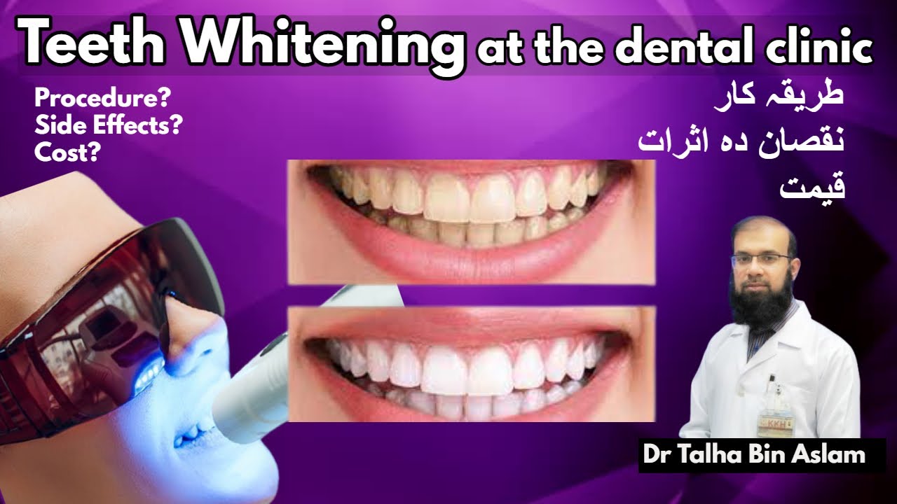 Teeth Whitening treatment at dentist. By Dr Talha Bin Aslam