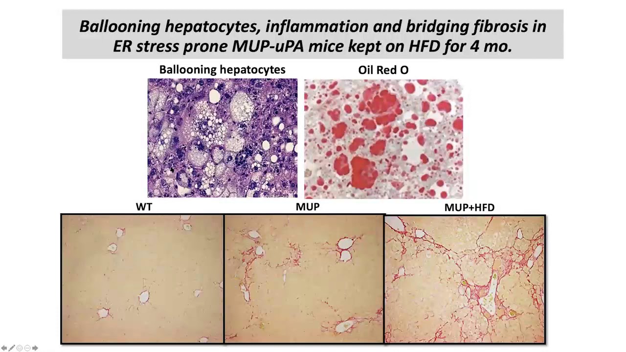 Inflammation, Metabolism and Immunity in Liver Cancer: From Pathogenesis to Treatment