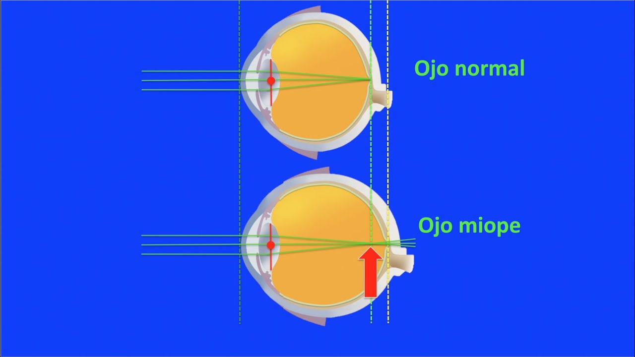 Optica ocular: miopía, hipermetropía y astigmatismo. Centro de Oftalmología Bonafonte. Barcelona.