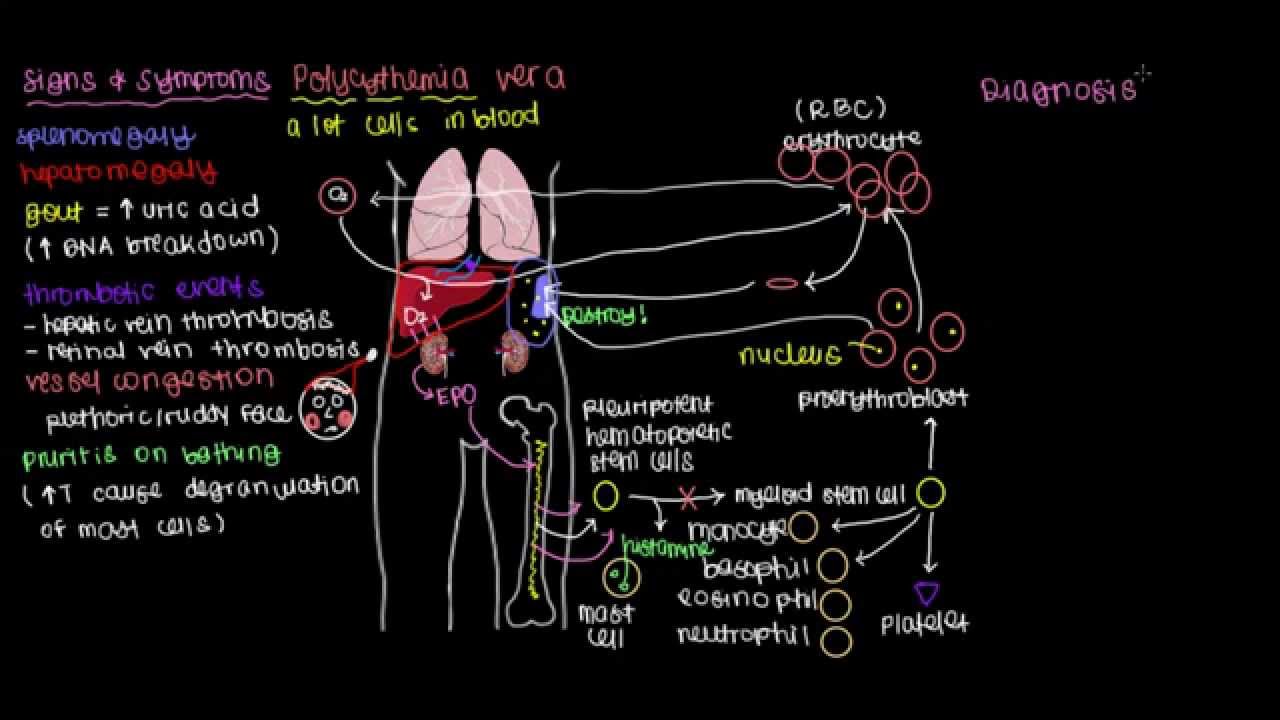 What is polycythemia vera?