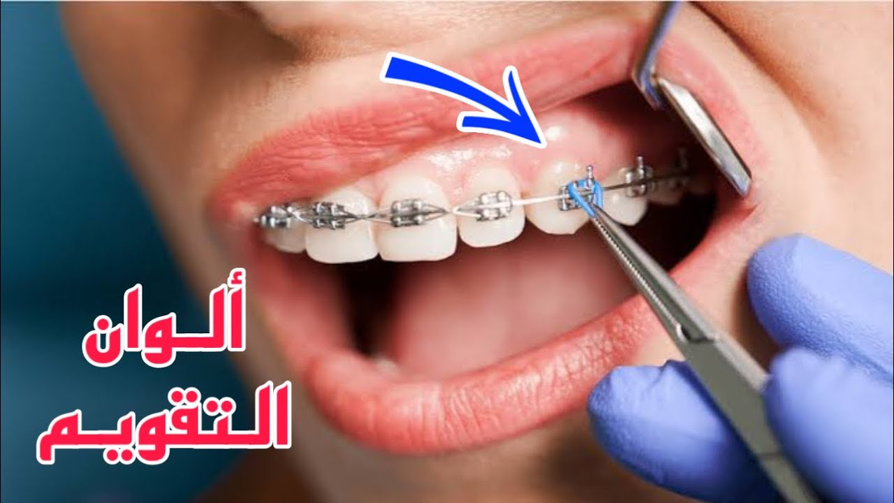 ألوان تقويم الأسنان - أسلاك التقويم