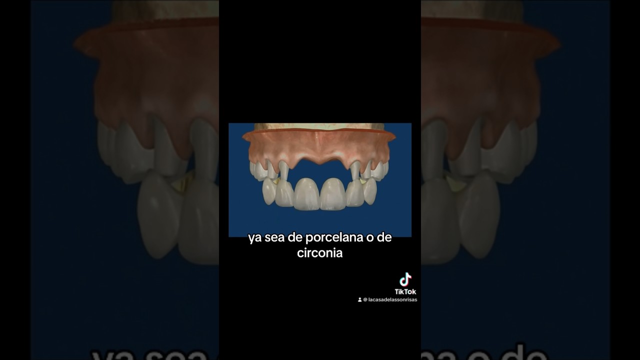 🟢 #tipsdentales Puente dental de 6 unidades para sustituir dientes faltantes 😀❤️