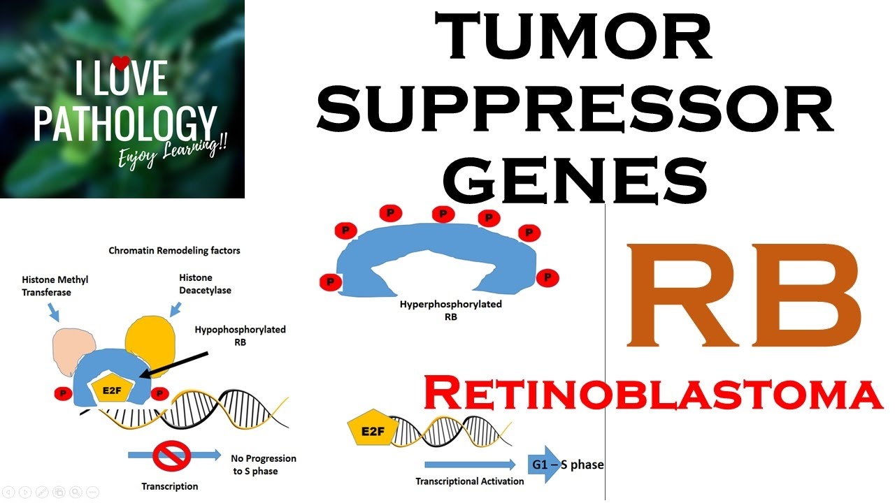 NEOPLASIA 3: TUMOR SUPPRESSOR GENES: Retinoblastoma Gene, Knudson's Two Hit Hypothesis.