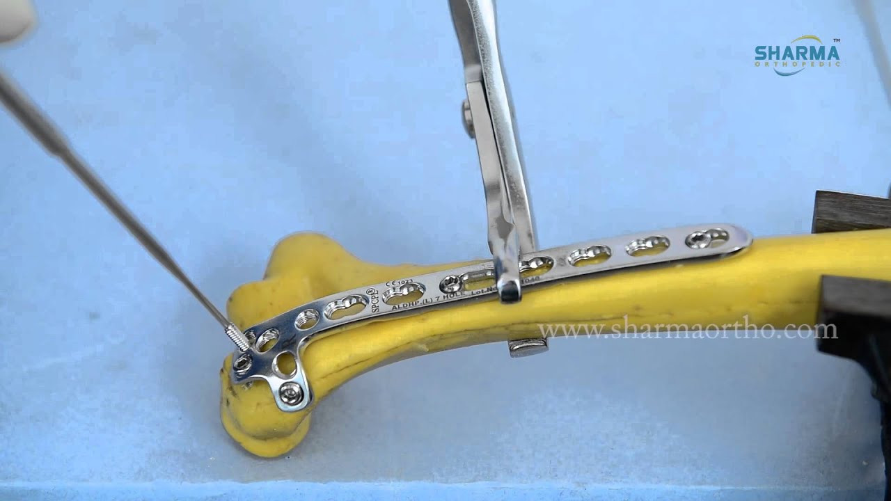 LCP Posterolateral Distal Humerus Plates, with support and LCP Medial Distal Humerus Plate