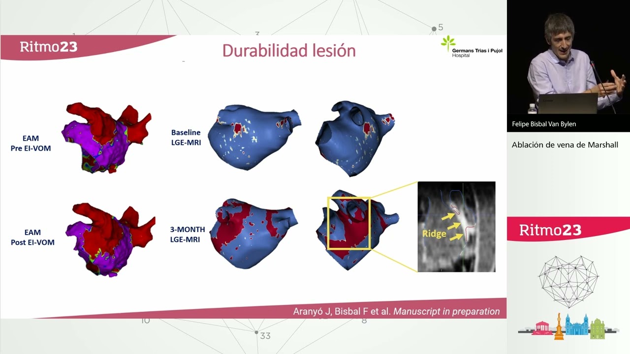 Estrategias de ablación en fibrilación auricular