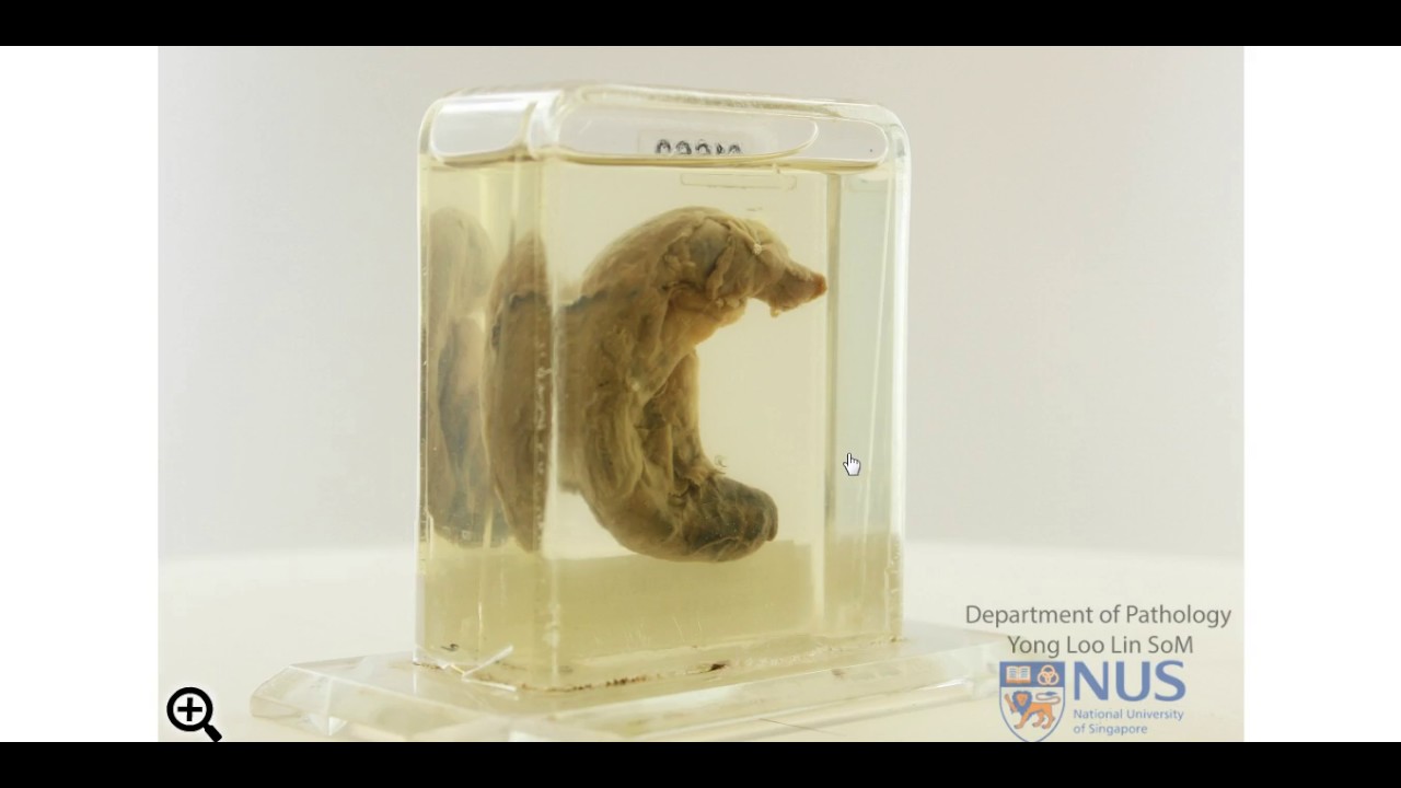 Acute appendicitis: Gross pathology