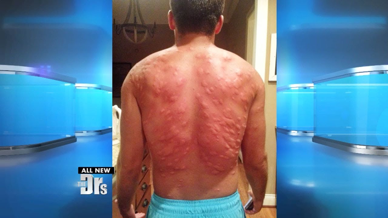 Man Suffers Worst Mosquito Attack Ever