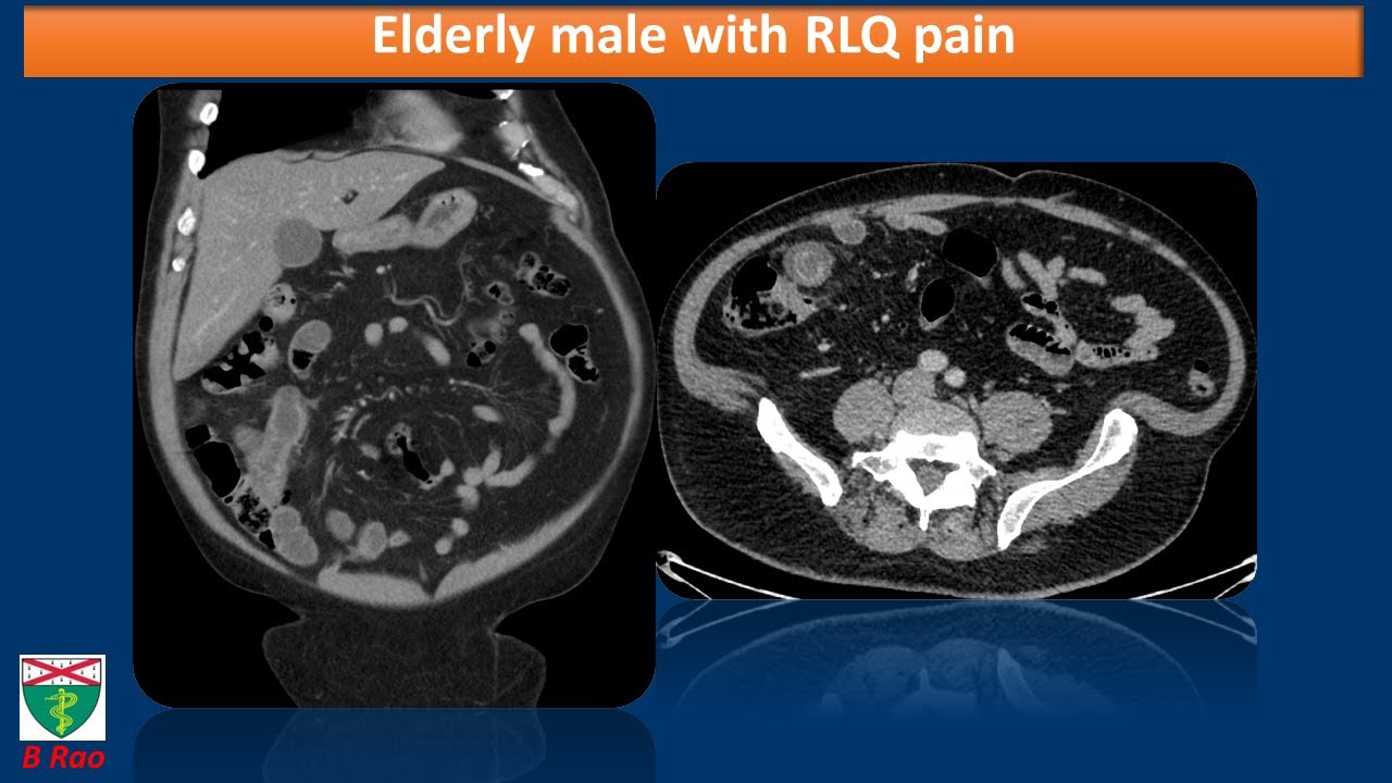 Meckel's diveritculitis