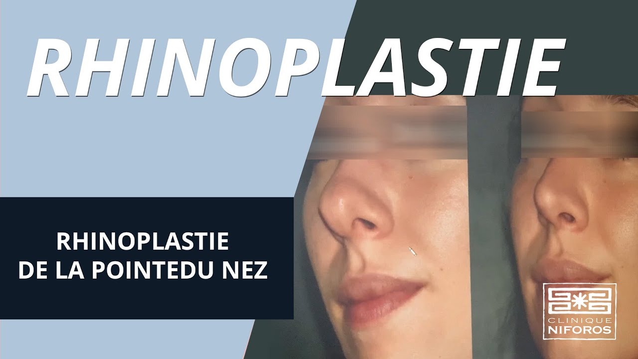 Rhinoplastie pour affiner la pointe du nez - Dr Niforos chirurgien esthétique