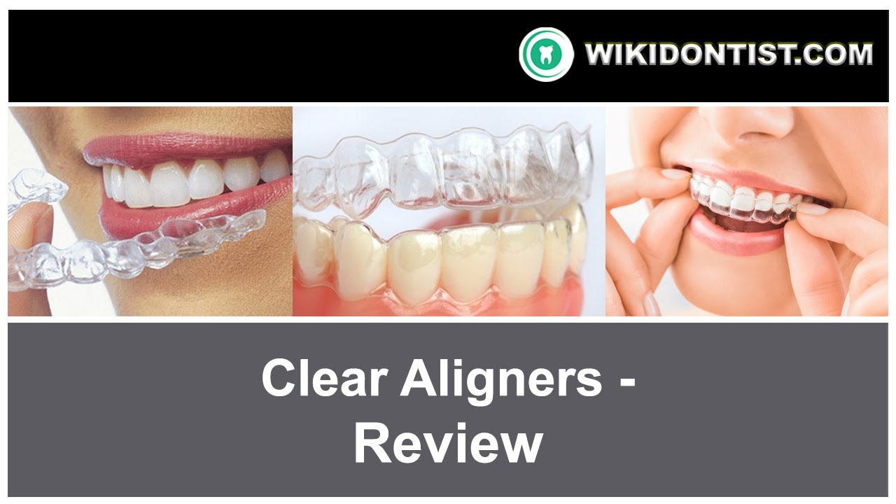 Clear Aligners -Review...