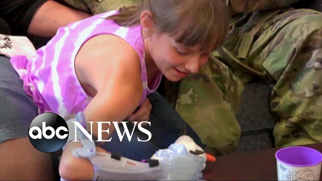 Girl Gets Frozen Themed Prosthetic Hand