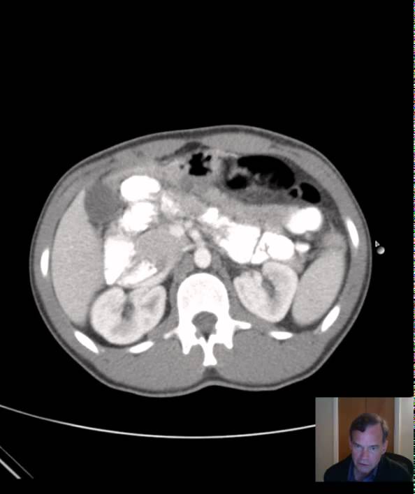 CT Distal Small Bowel Obstruction