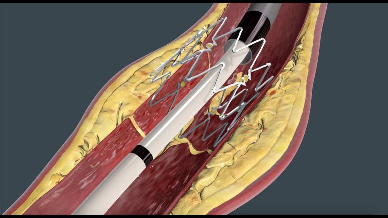 Tack Endovascular System® mechanism of action (MOA)