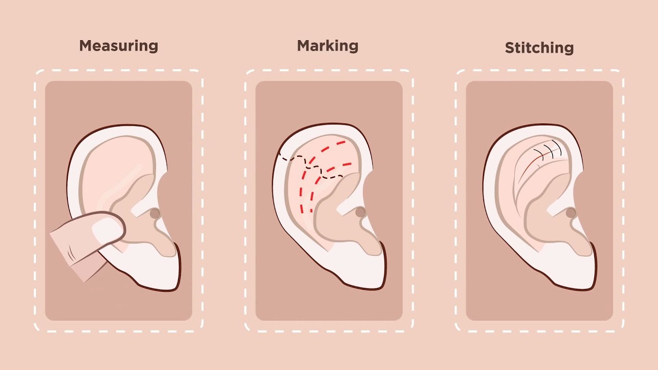 Otoplasty: Common Questions About Ear Pinning