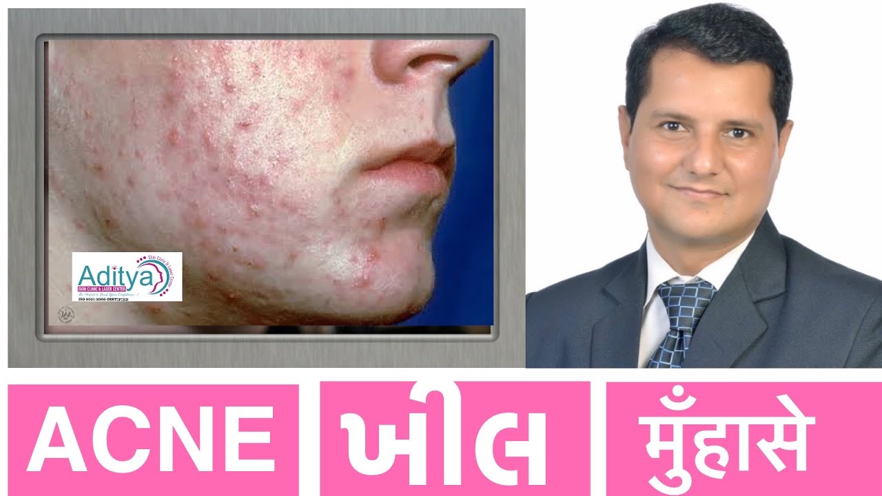 BEST ACNE (ખીલ / मुँहासे/पिंपल्स  का पूरा ट्रीटमेंट )TREATMENT BY DR PRIYANK SEN (SKIN SPECIALIST )