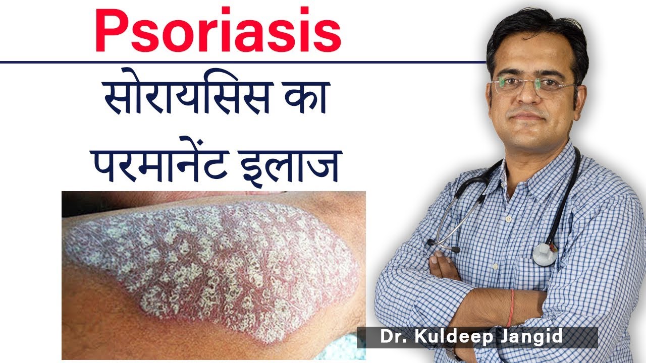 Psoriasis (सोरैसीस) Permanent Treatment | सोरैसीस का पूरा सफल इलाज | Best Homeopathic Doctor