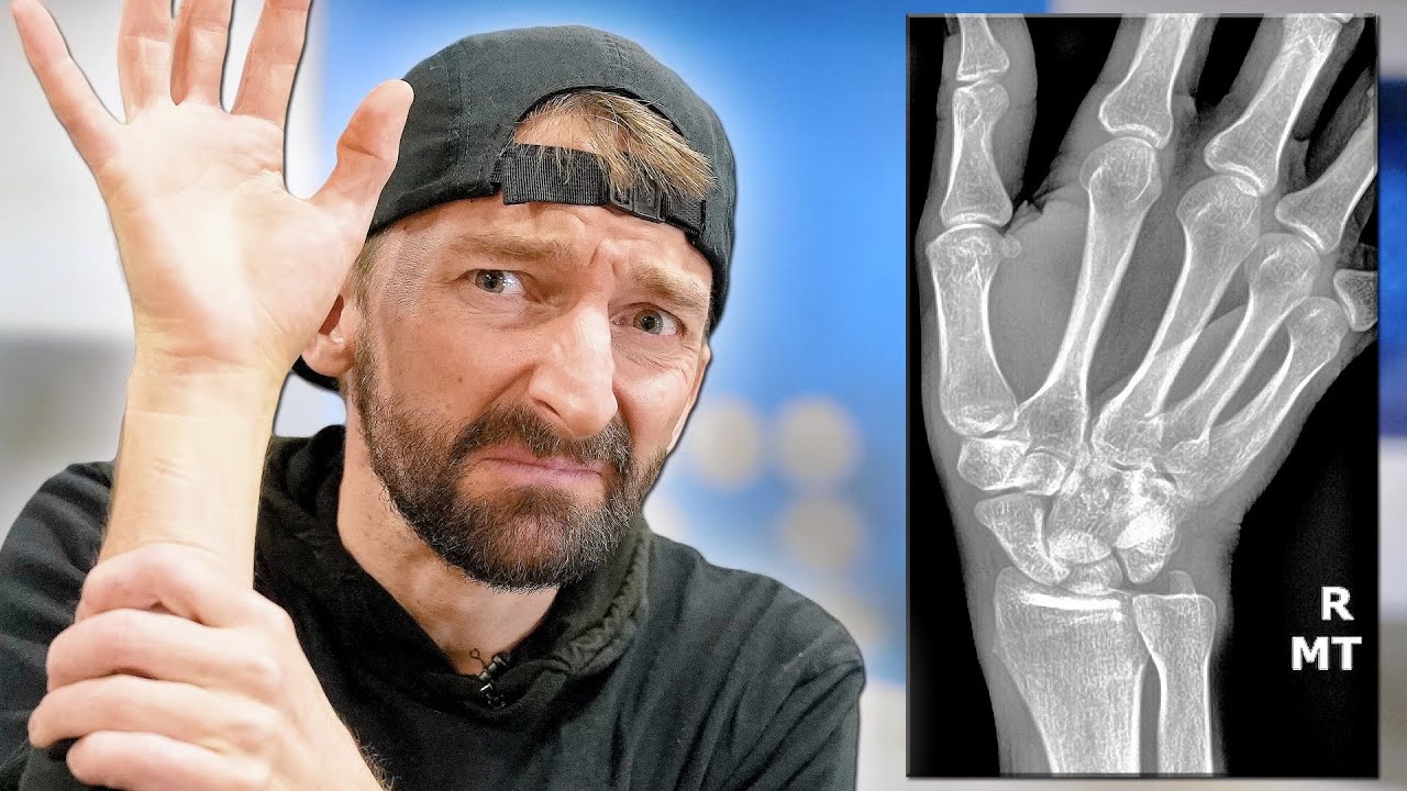 I broke my wrist.