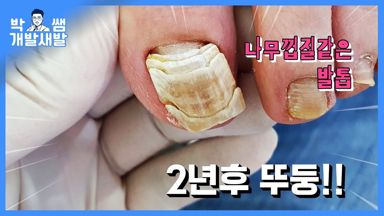 거북이 등껍질 같은 두꺼운 발톱, 2년간 손상된발톱 파고드는내성발톱 관리 후기 [풋스올영등포당산점]