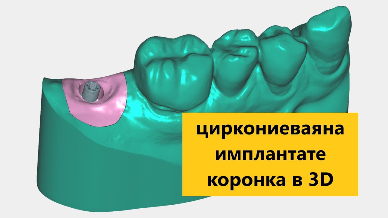 Циркониевая коронка на импланте. Моделируем в EXOCAD. Exocad crown design