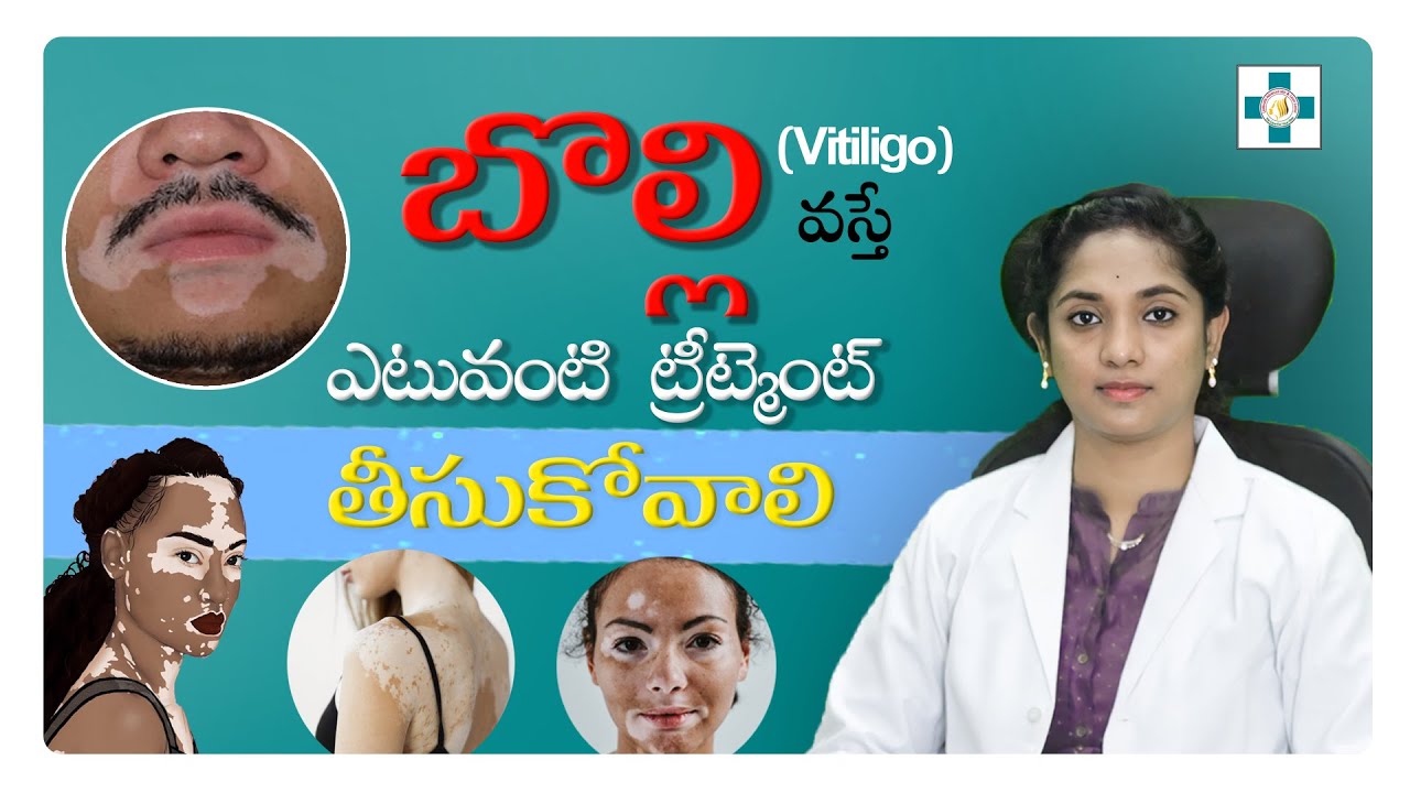 Vitiligo (బొల్లి మచ్చలుBest) || Treatment For Vitiligo || In Telugu || Dr. Kavya Chennamsetty