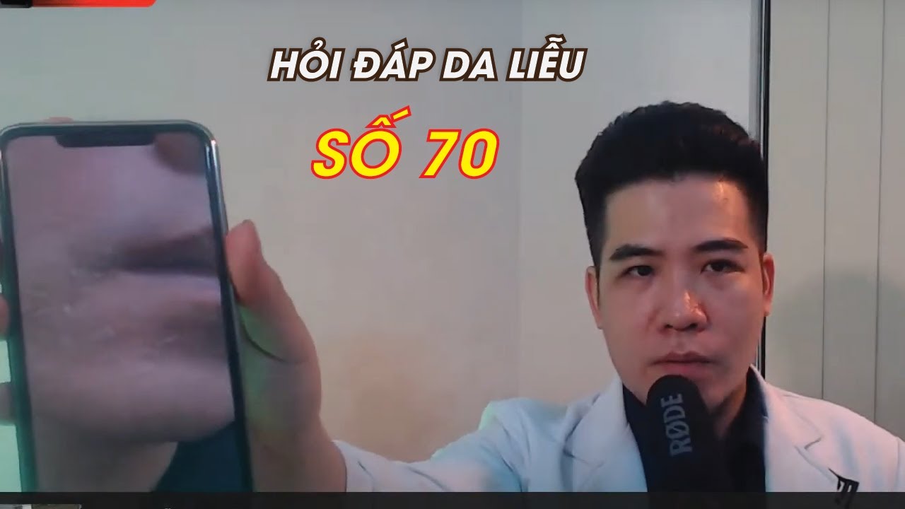 HỎI ĐÁP DA LIỄU số 70 | Chia sẻ cách trị NÁM - MỤN ngày dịch tại nhà