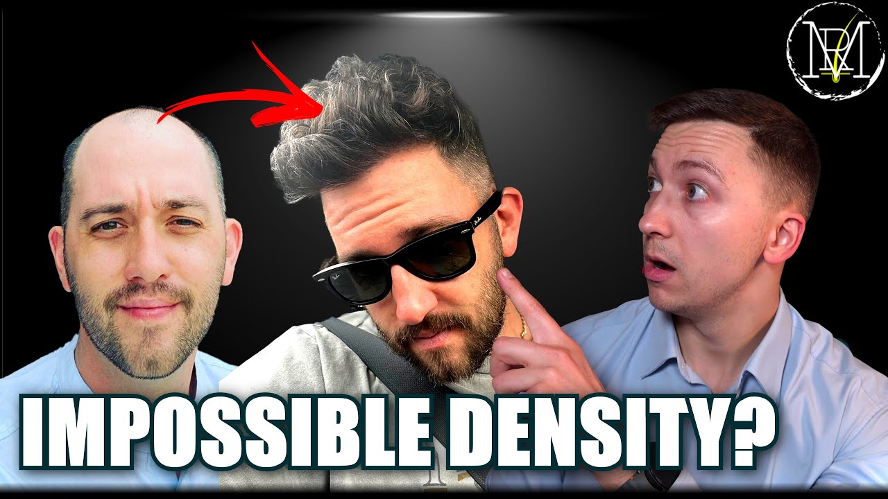 Bald to Model in 1 surgery? Why You Can't Replicate This