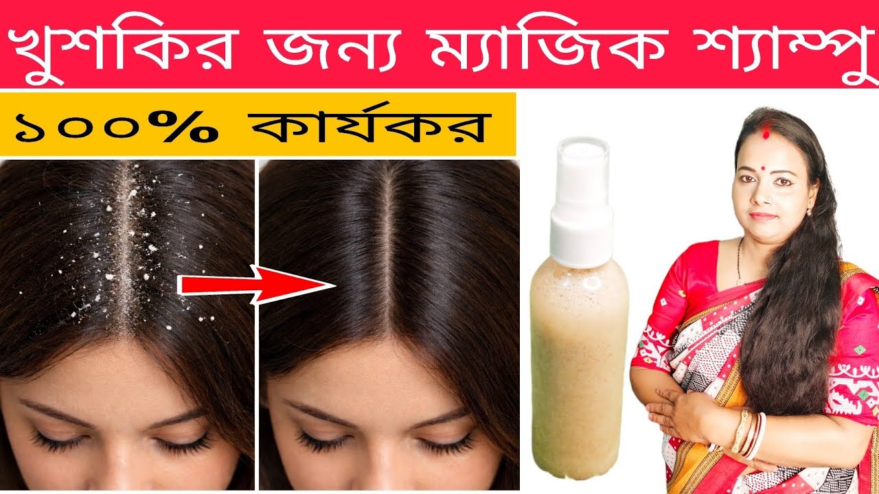 ঘরে বসেই খুশকি দূর করার শ্যাম্পু বানিয়ে নিন।। Make anti dandruff shampoo at home easily..