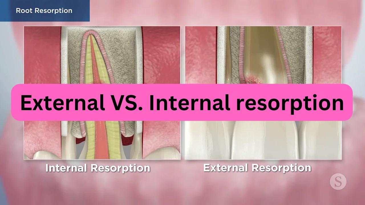 INTERNAL VS  EXTERNAL RESORPTION in dentistry