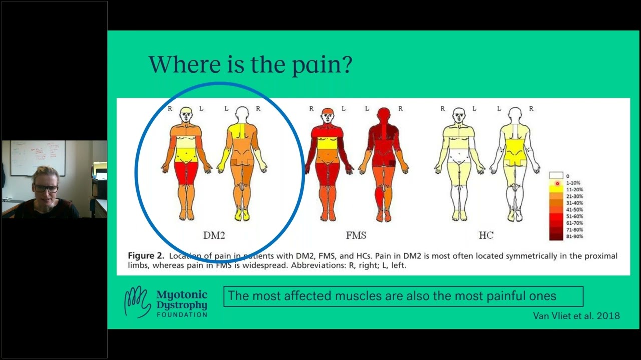 Ask-the-Expert: Myotonic Dystrophy Type 2 & Pain Management