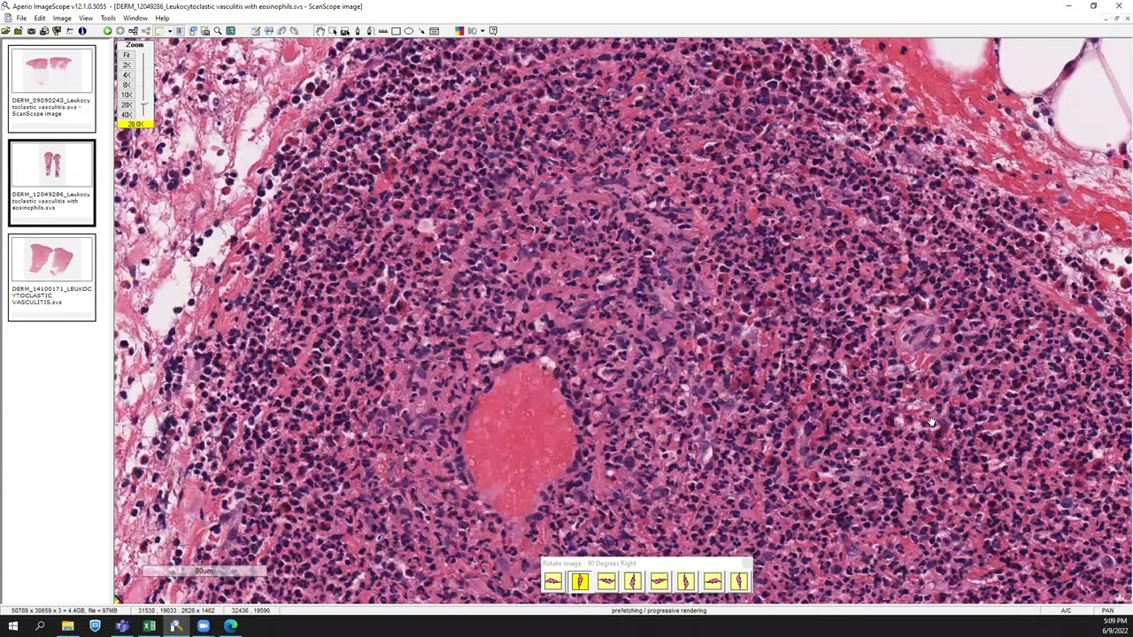Leukocytoclastic vasculitis.
