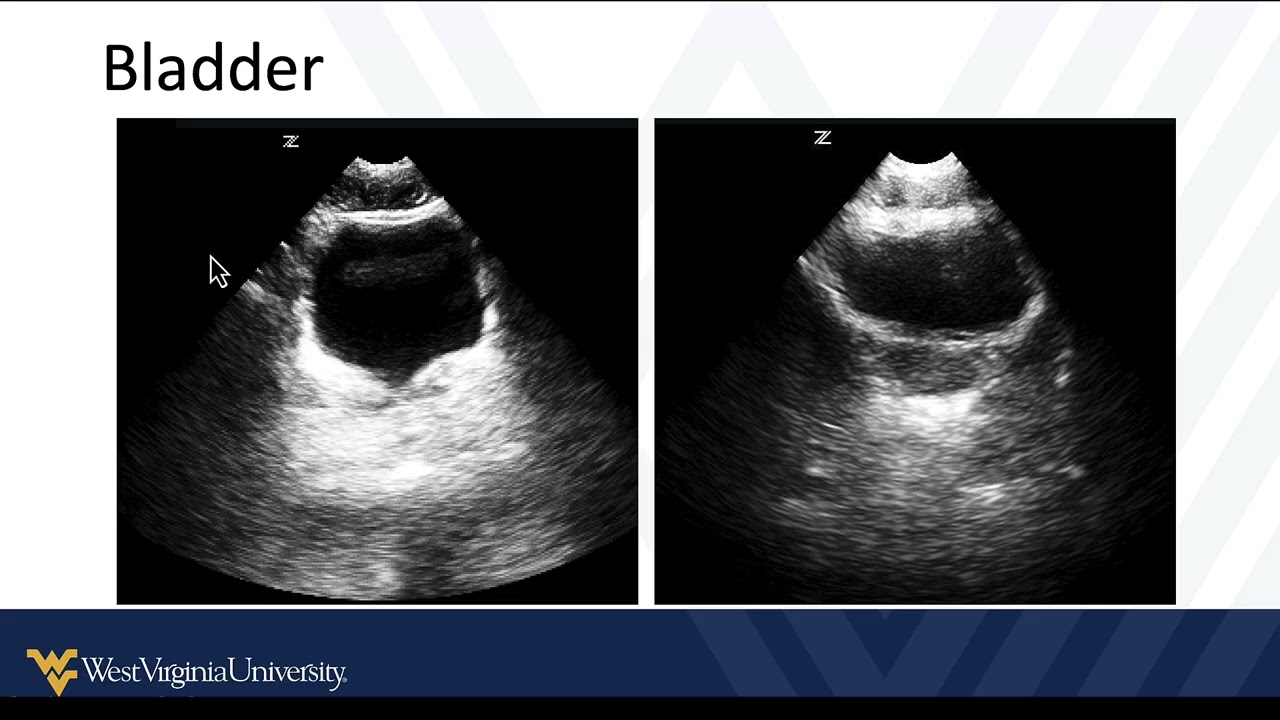 M3 POCUS Cases Pediatrics Renal