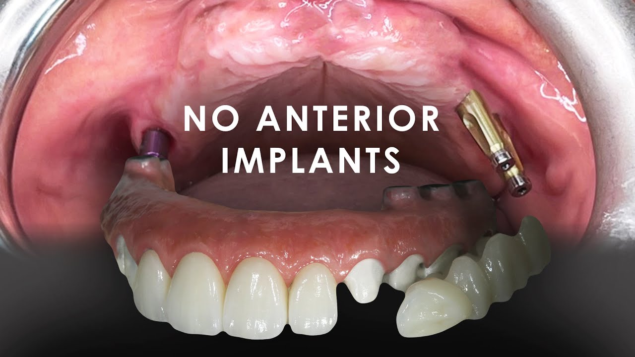 A Slim Full Mouth Solution with No Anterior Implants
