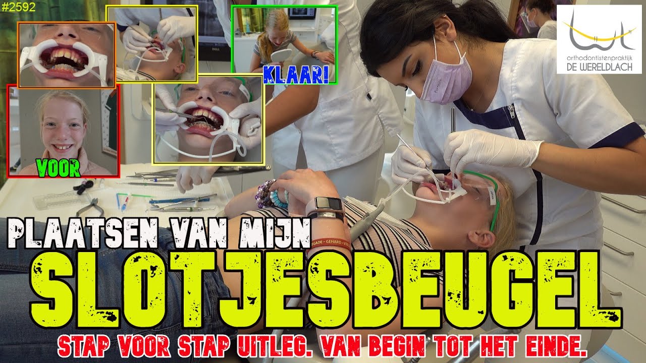 IK KRIJG MIJN BEUGEL. SLOTJESBEUGEL plaatsen door ORTHODONTIST, Stap voor Stap uitgelegd #2592
