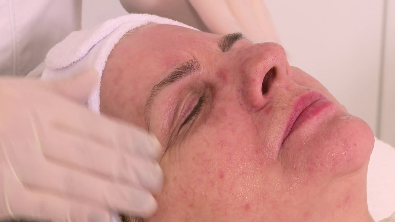 Peelingi chemiczne - Kosmofakty