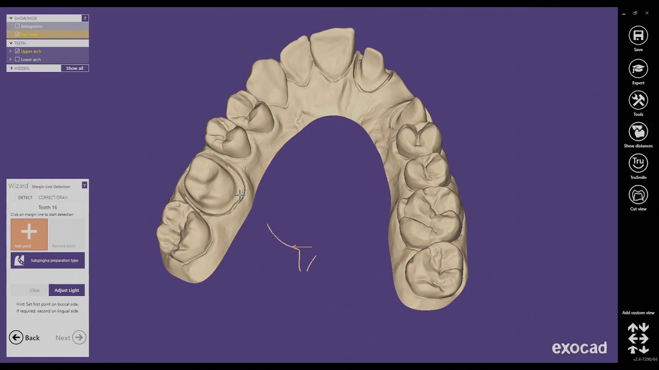 Form 3B - Removable Die Models in ExoCAD Model Creator