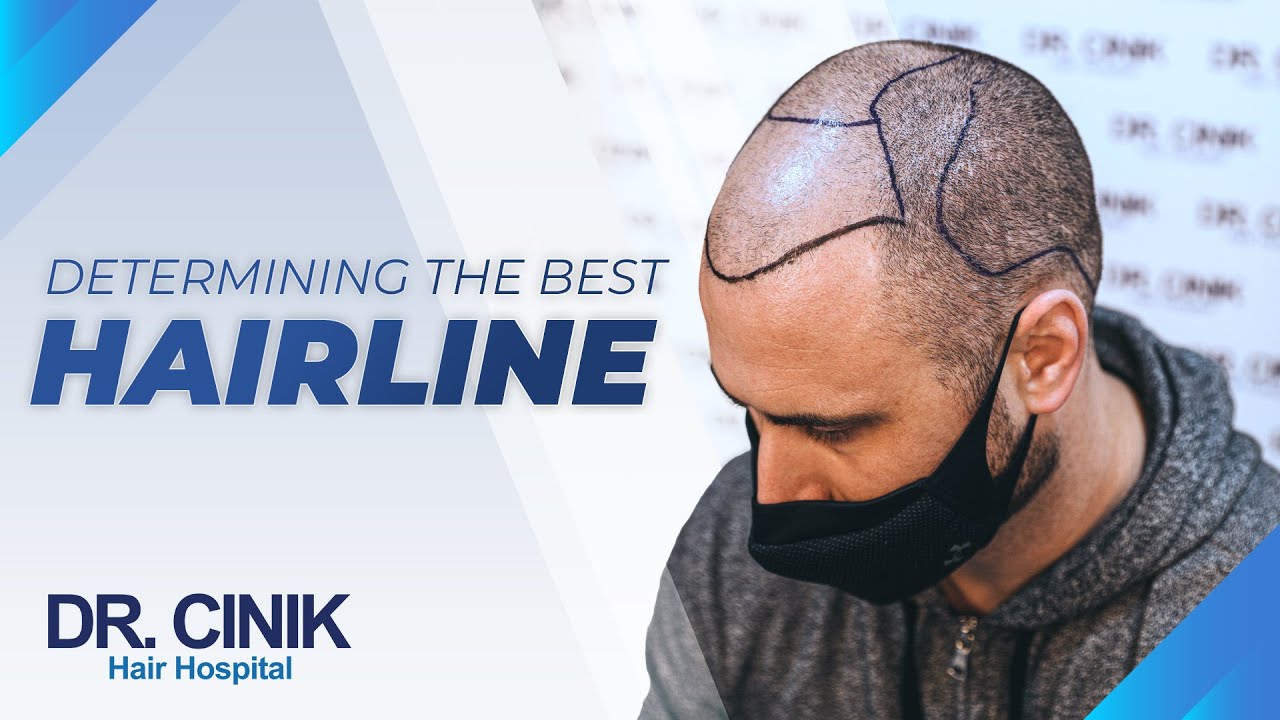 Determining The Best Hairline | Hair Transplant | Dr. Emrah Cinik