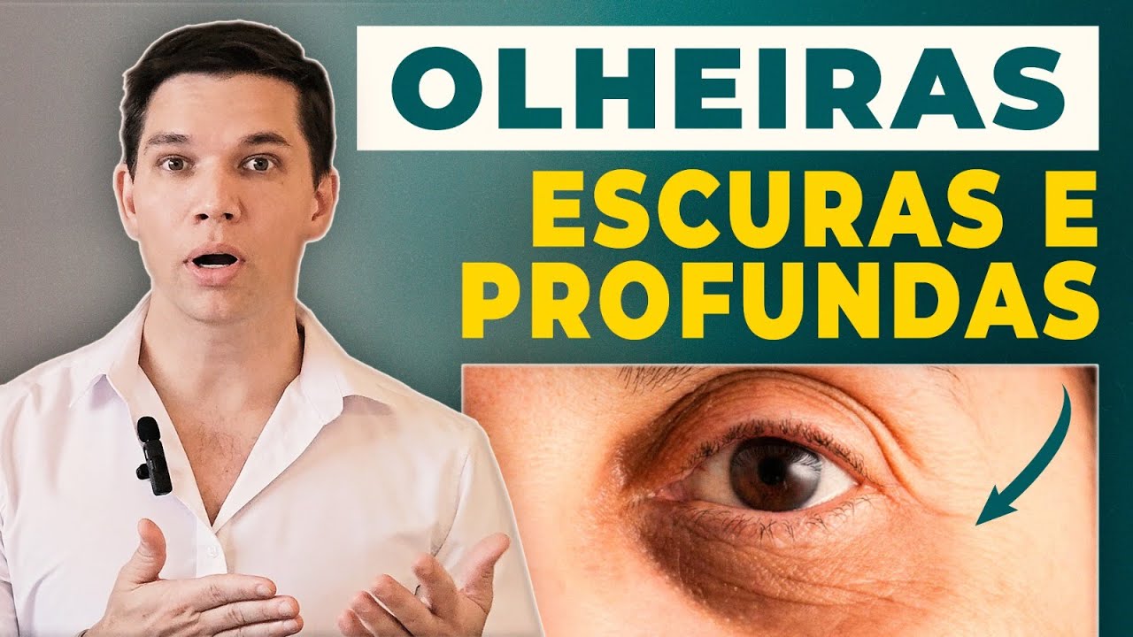 Como tratar olheiras ESCURAS e PROFUNDAS