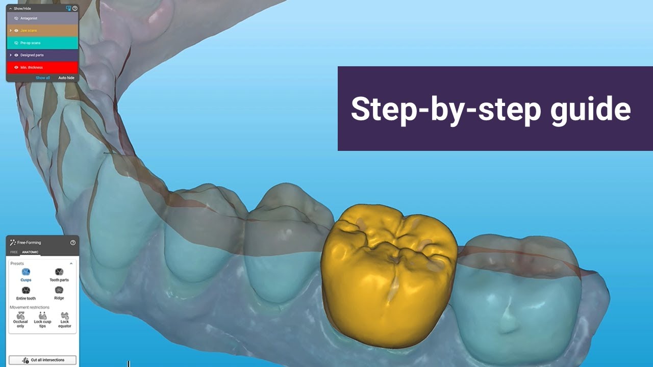 How to design and 3-D print crowns in-house with iTero™ Design Suite