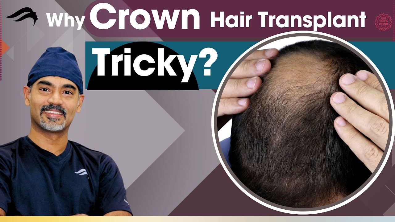 Hair Transplant In Bangalore | Best Clinic Surgeon & Results Of Hair Transplant In Bangalore