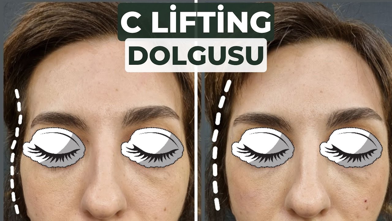DR. BUKET ŞENKAYA İLE C LİFTİNG DOLGUSU