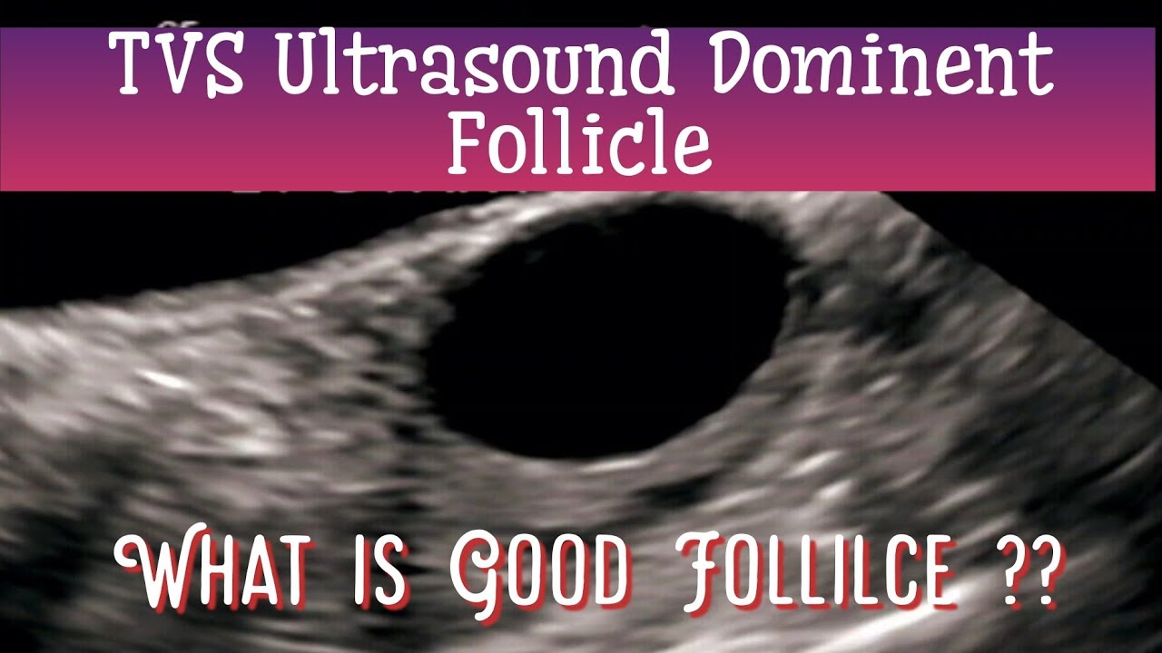 TVS Ultrasound Dominent Follicular Study , 14 Day Follicular monitoring , What is GOOD Follicle ??