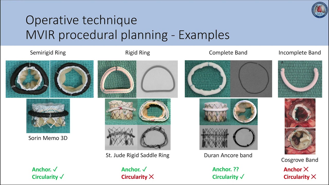 Mitral valve-in-valve and valve-in-ring: tips, tricks, and outcomes