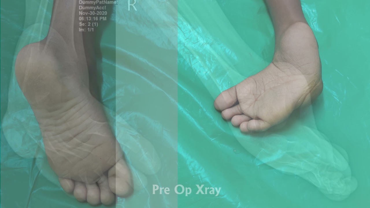 #Neglected Club Foot | Dr Lenin Babu | Evans procedure or Triple Arthrodesis