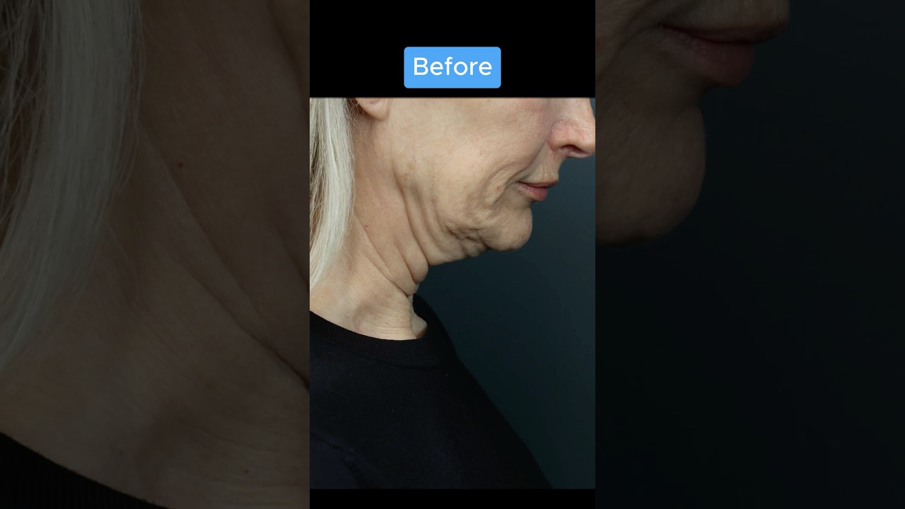 INSANE FACELIFT TRANSFORMATION