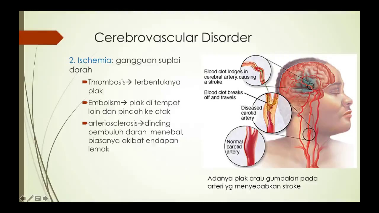 Neuroplastisitas dan kerusakan otak