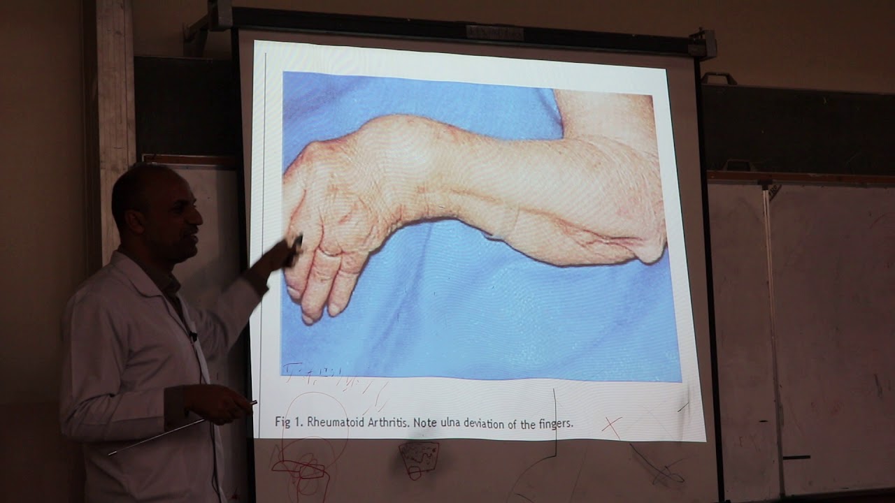 Rheumatoid Arthritis. By Dr. Dheyaa Jabbar