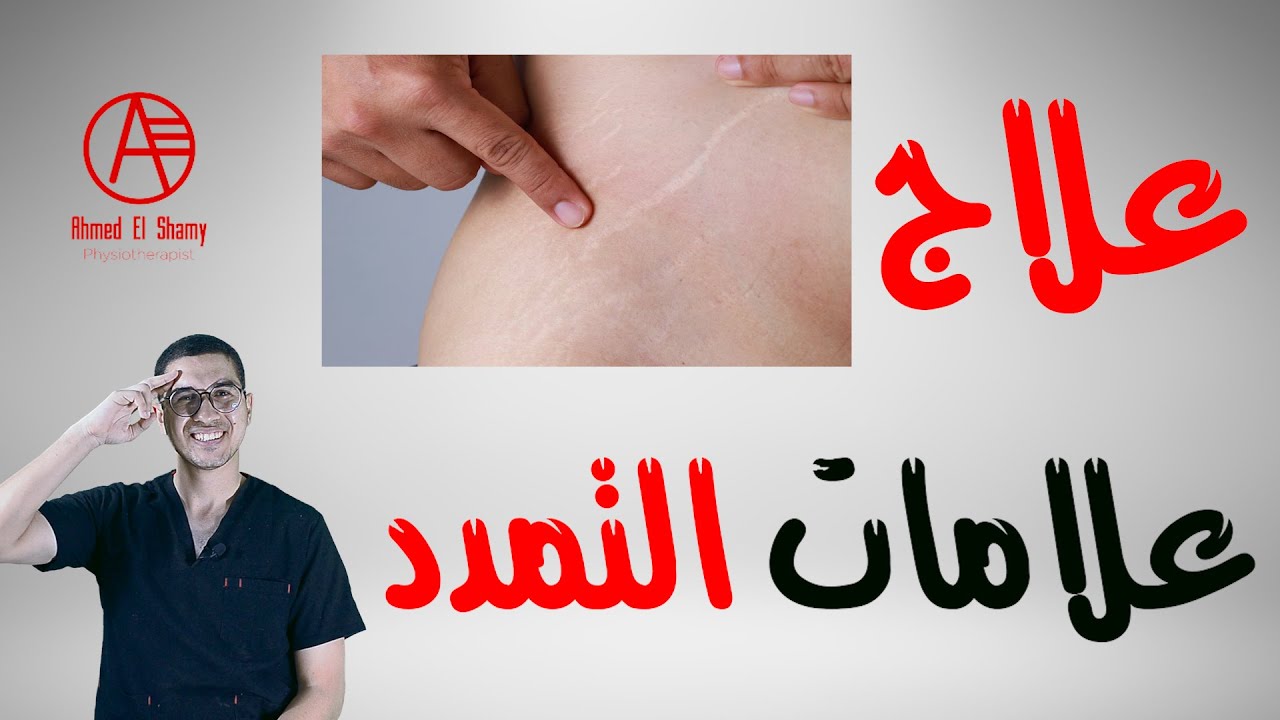 علاج علامات التمدد | اسباب علامات التمدد وكيفية الحماية منها - Stretch marks