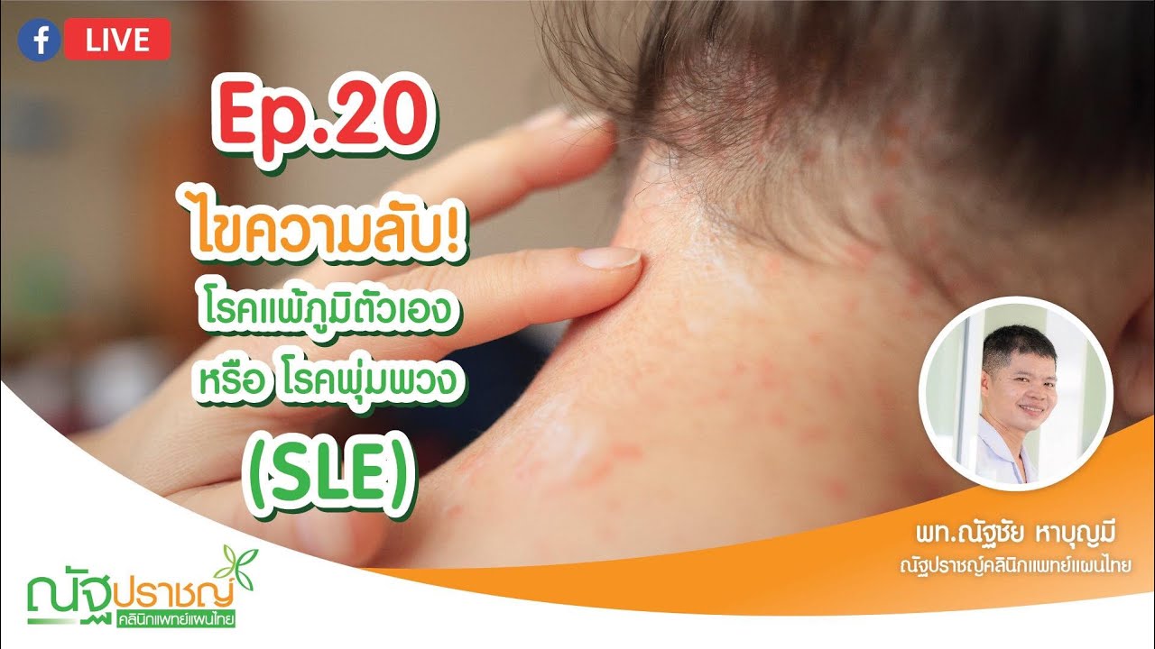 Ep20:ไขความลับวิธีรักษาโรคแพ้ภูมิตัวเองหรือโรคพุ่มพวง ( SLE )