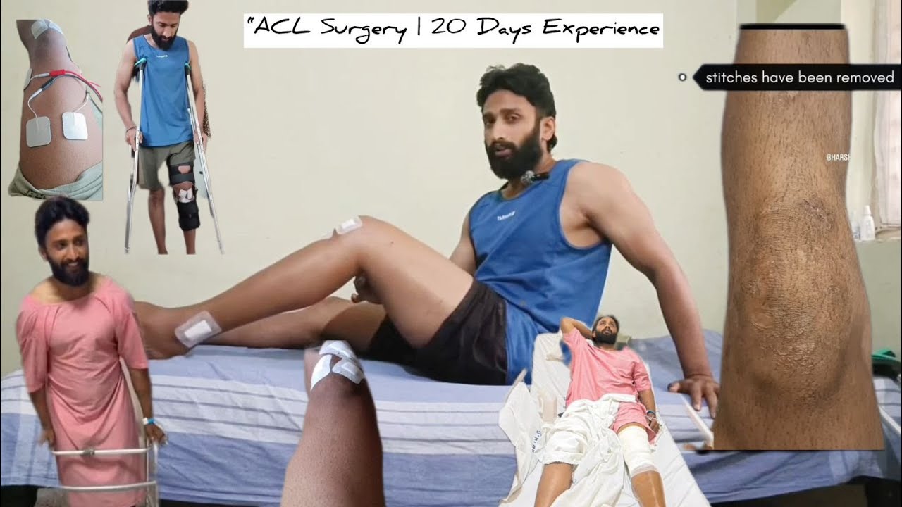 20 Days After ACL Surgery | Pain, Rehab, Progress and information about the recovery 