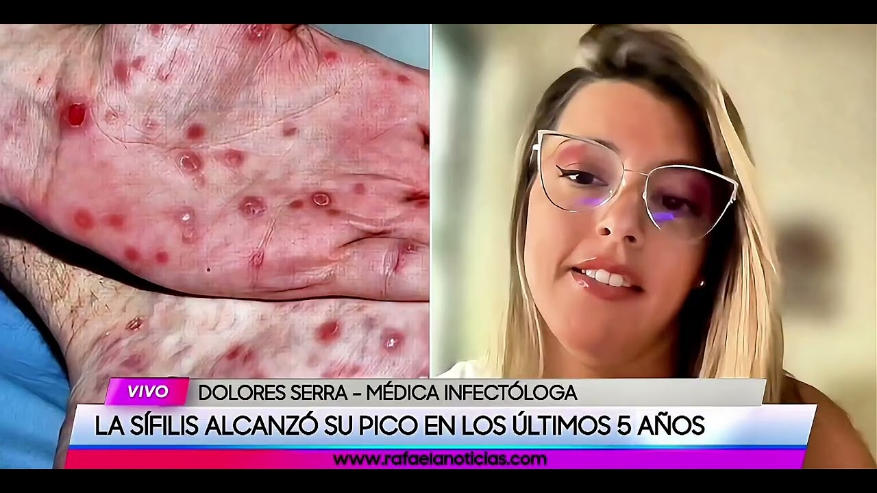 Aumento de casos de SIFILIS EN ARGENTINA. Entrevista para @RAFAELANOTICIASOFICIAL 21/1/26